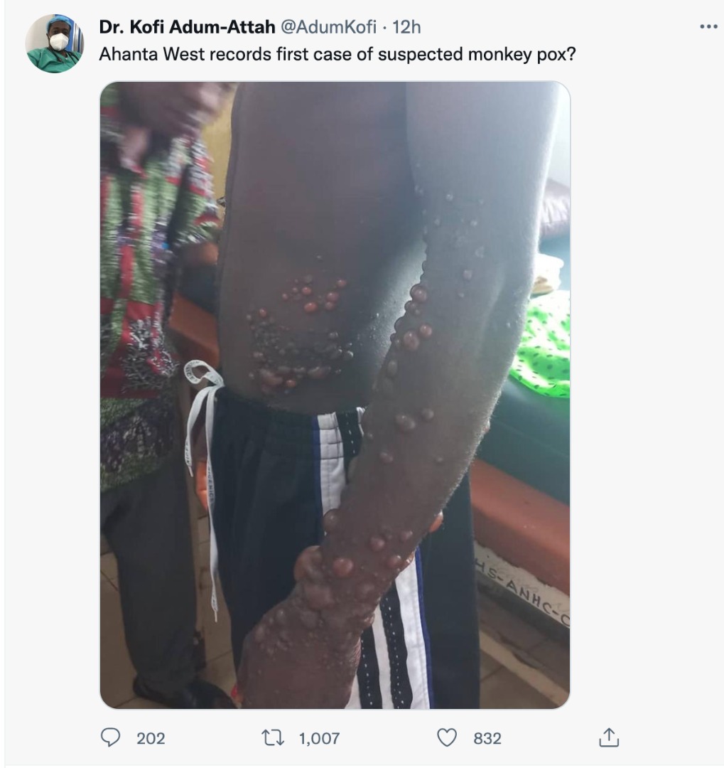 FACT-CHECK: Ghana has NOT recorded a case of Monkeypox