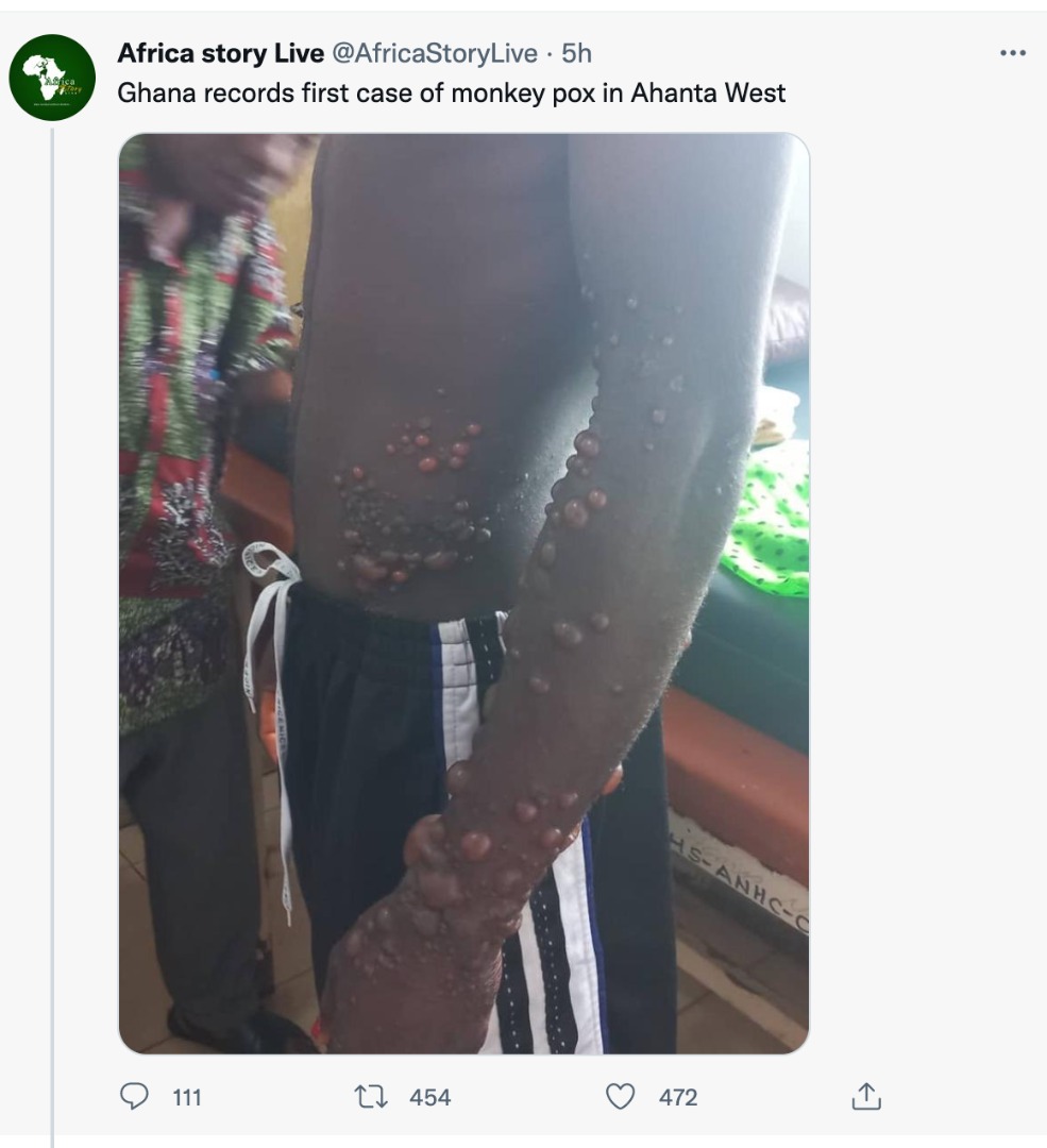 FACT-CHECK: Ghana has NOT recorded a case of Monkeypox