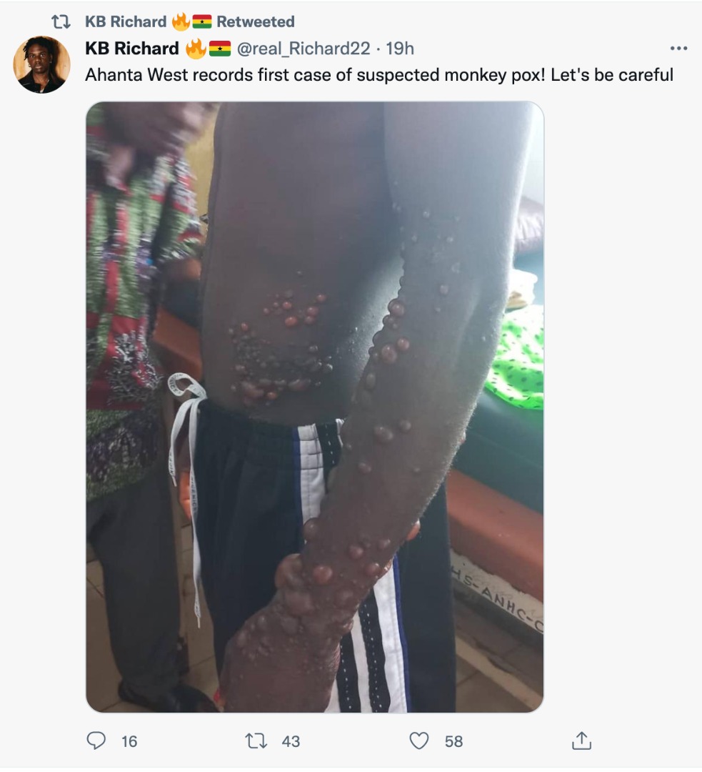 FACT-CHECK: Ghana has NOT recorded a case of Monkeypox