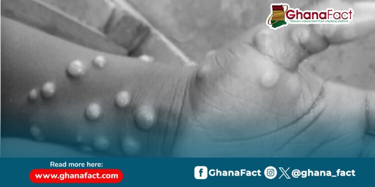 False! Recent Mpox death is not the first since June 2022 